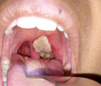 FG activates task force over diphtheria outbreak in Katsina, Kano